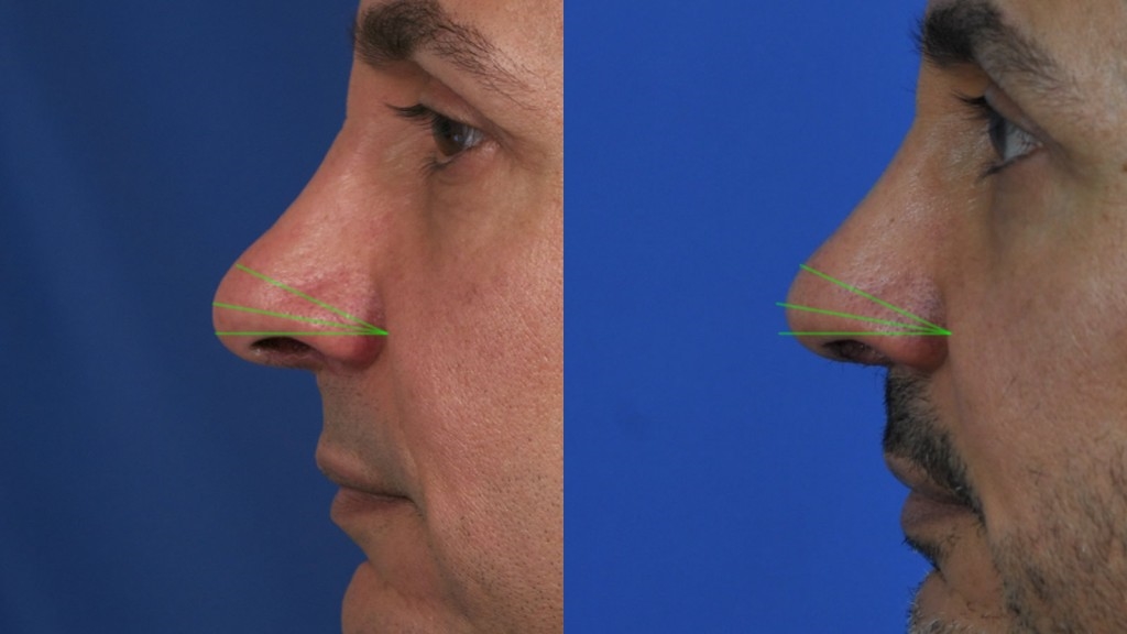 thick skin rhinoplasty expert